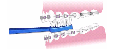 periajul dinţilor cu aparat dentar